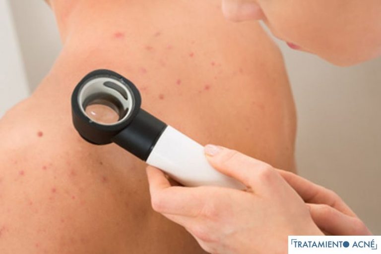 Lee más sobre el artículo Tratamiento del acné de la espalda y del cuerpo